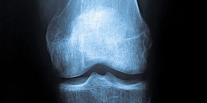 Артроз колінного суглоба (гонартроз)